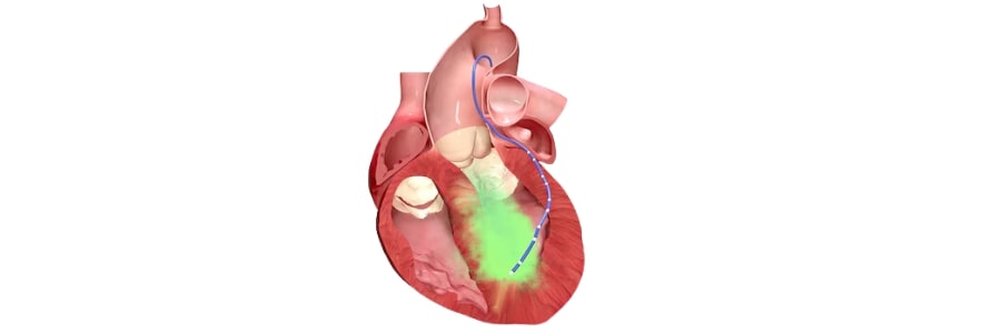 Alcohol Septal Ablation