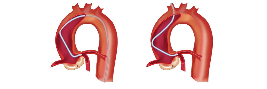 Coronary Angiography