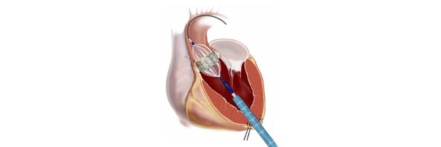 Balloon Pulmonic Valvuloplasty