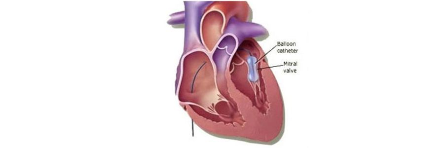 Balloon Mitral Valvuloplasty