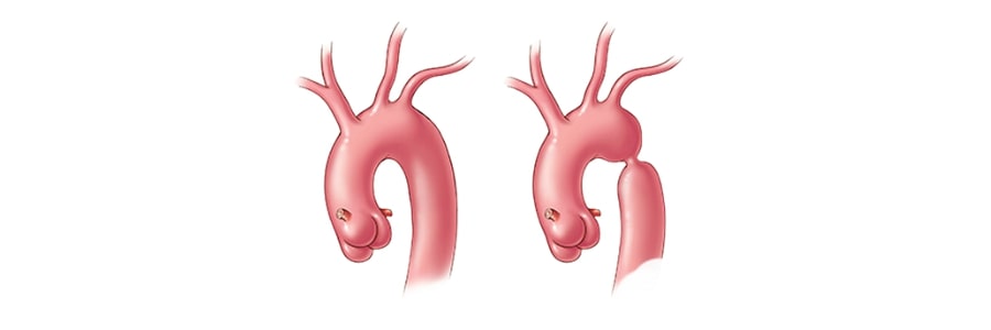 Coarctoplasty