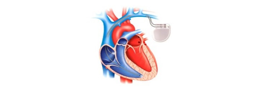 Conventional Single and Dual Chamber Pacemaker Implantation