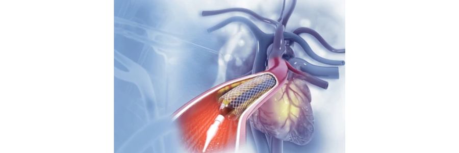 Coronary Angioplasty With Stent