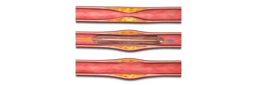 Coronary Angioplasty Without Stent