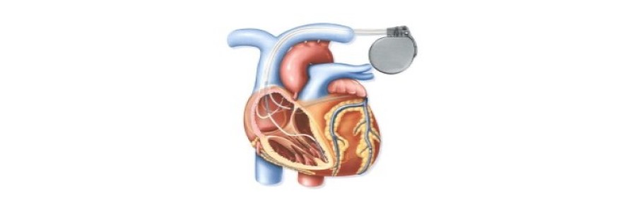 Cardiac Resynchronization Therapy