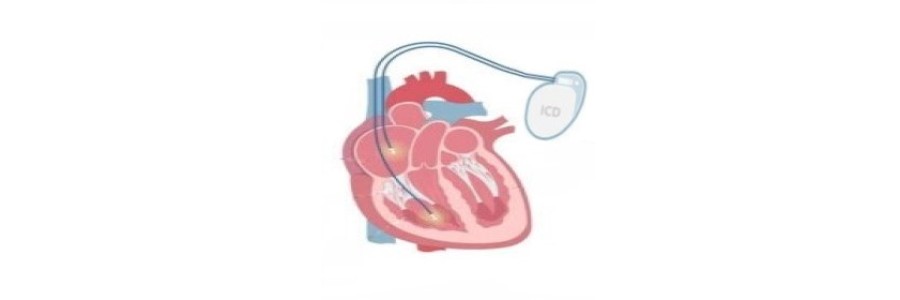 Implantable Cardioverter Defibrillator