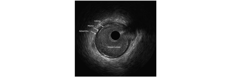 Intracoronary Imaging and Physiology Studies