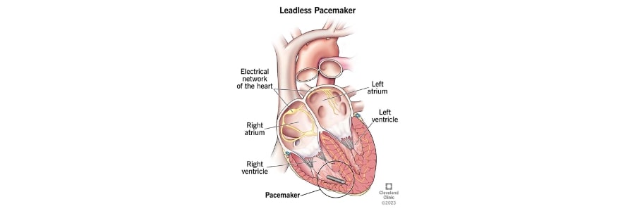 Leadless Pacemaker Advancement in Heart Care