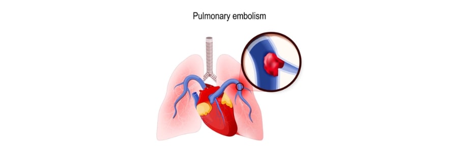 Pulmonary Embolectomy Life Saving Procedure