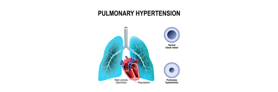 Pulmonary Hypertension Management