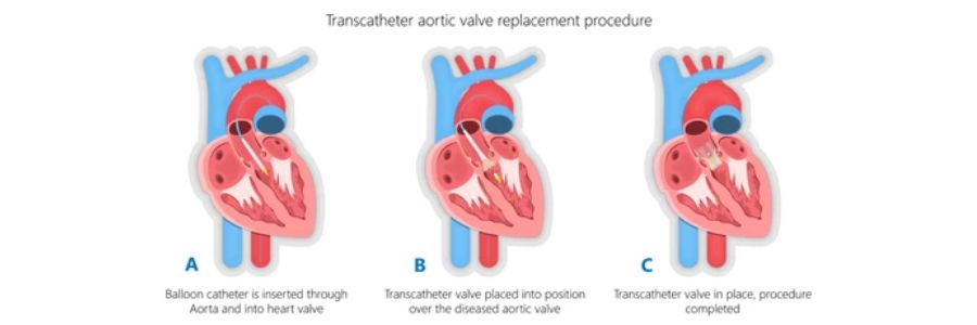 Transcatheter Aortic Valve Implantation